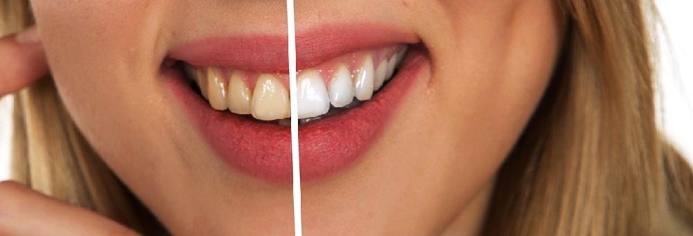 Nowoczesne metody wybielania zębów
